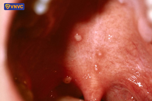 mụn nước thủy đậu trong miệng