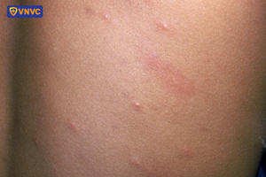mụn nước thủy đậu