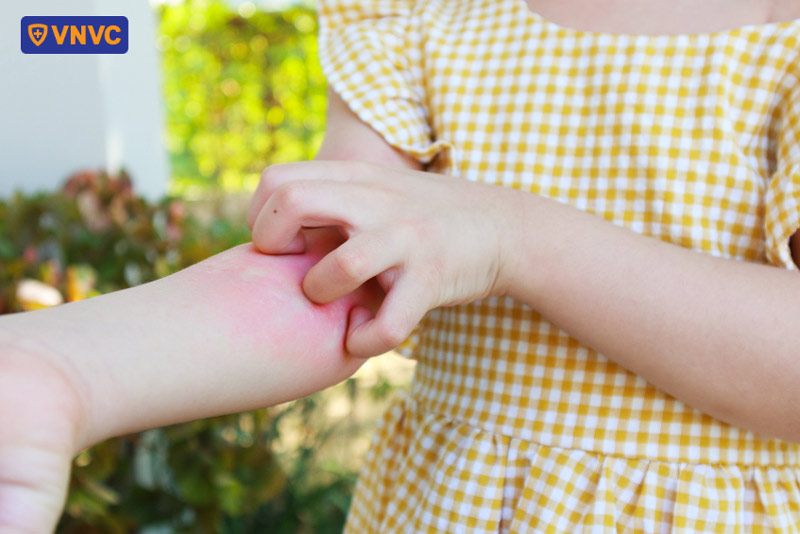 ngứa khi bị sốt xuất huyết