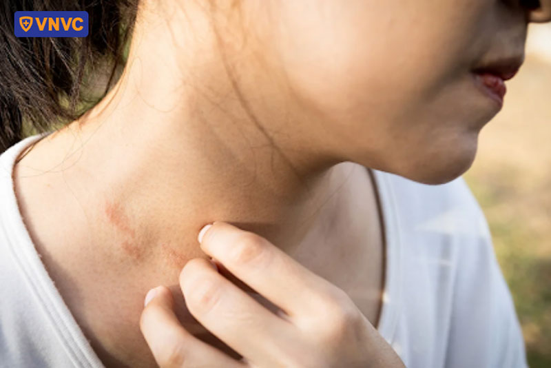 người bệnh zona cảm thấy tê ngứa vùng cổ