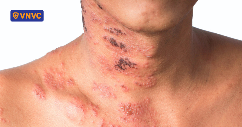 người mắc bệnh zona thần kinh