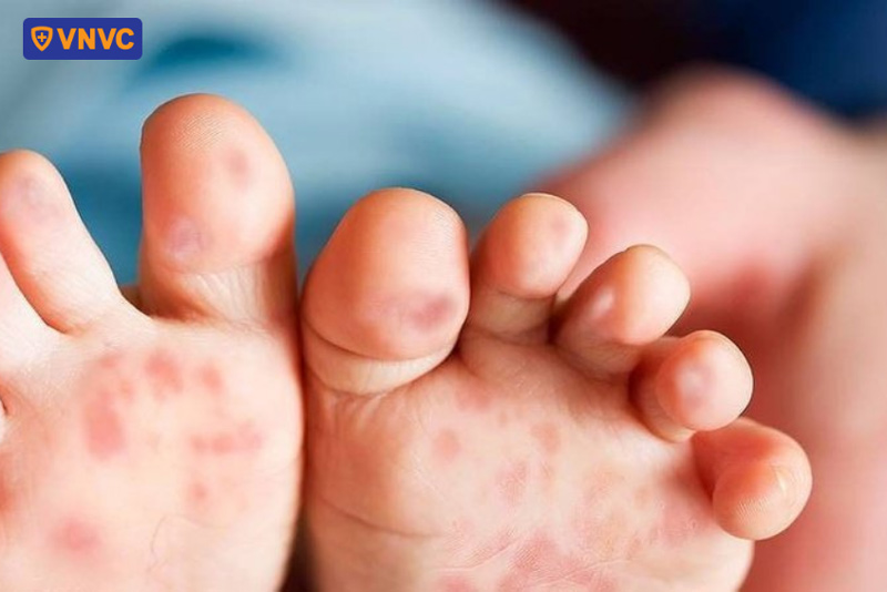 nốt tay chân miệng ở lòng bày chân