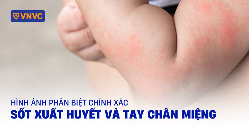 phân biệt sốt xuất huyết và tay chân miệng