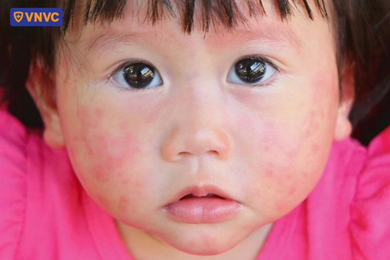 phát ban do sốt phát ban thường có dạng hồng ban mịn, sáng và ít nổi cao trên bề mặt da