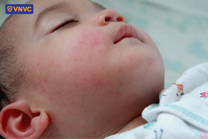 phát ban sẽ biến mất và không để lại sẹo hoặc vết thâm khi khỏi bệnh