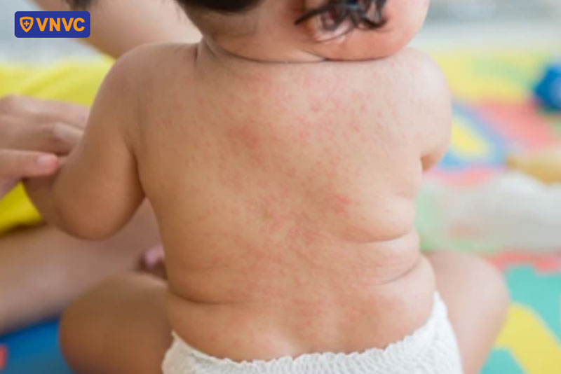 phát ban sốt xuất hiện trên cơ thể giảm dần và dần biến mất sau vài ngày