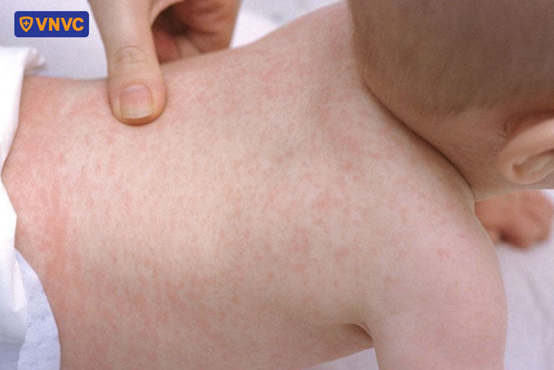 phát ban sốt xuất huyết thường xuất hiện dưới dạng đốm đỏ nhỏ