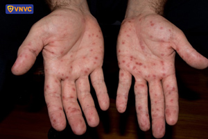 phát ban tay chân miệng ở tay