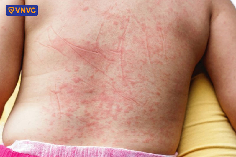 phát ban trong sốt xuất huyết