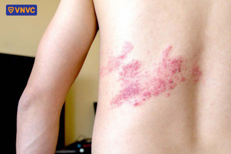 phát ban zona thần kinh giai đoạn bùng phát