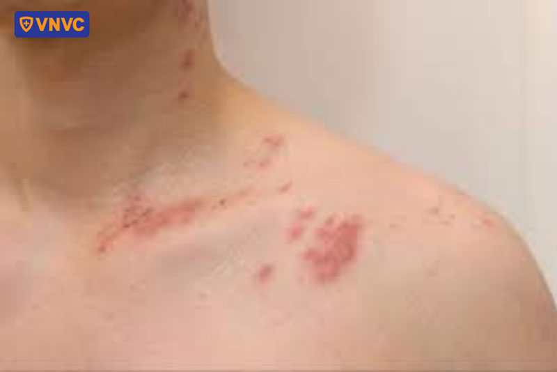 sẹo thâm hoặc các dấu vết nhẹ trên cổ