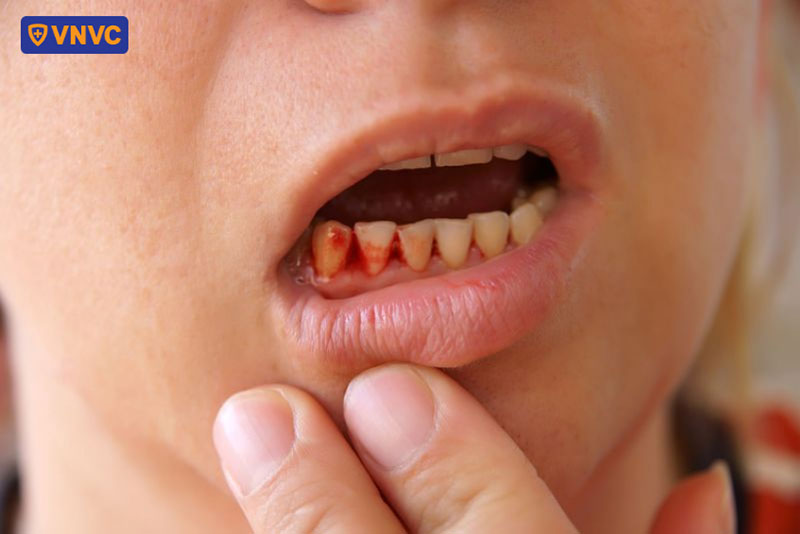 sốt xuất huyết có thể gây ra biểu hiện chảy máu chân răng