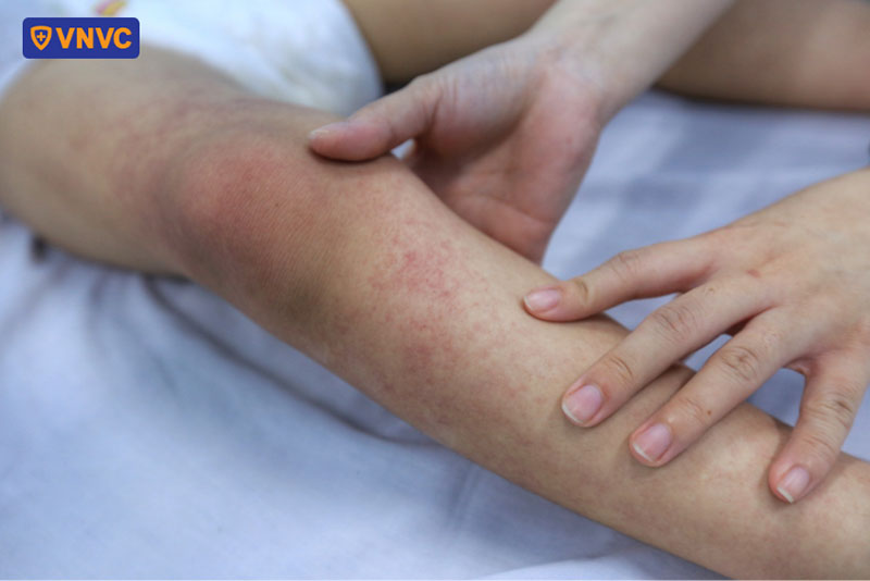 sốt xuất huyết là bệnh nhiễm trùng do virus dengue gây bệnh
