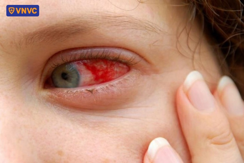 sốt xuất huyết thể não gây biến chứng về mắt