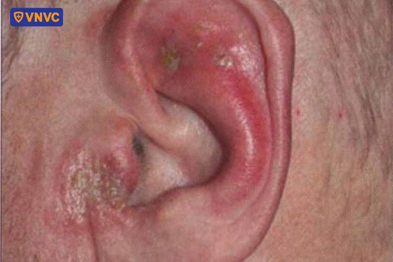 tai tổn thương vì bị zona thần kinh