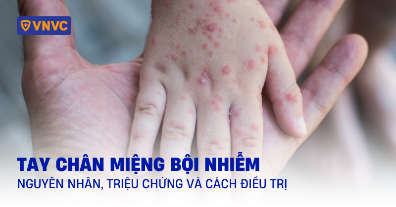 tay chân miệng bội nhiễm