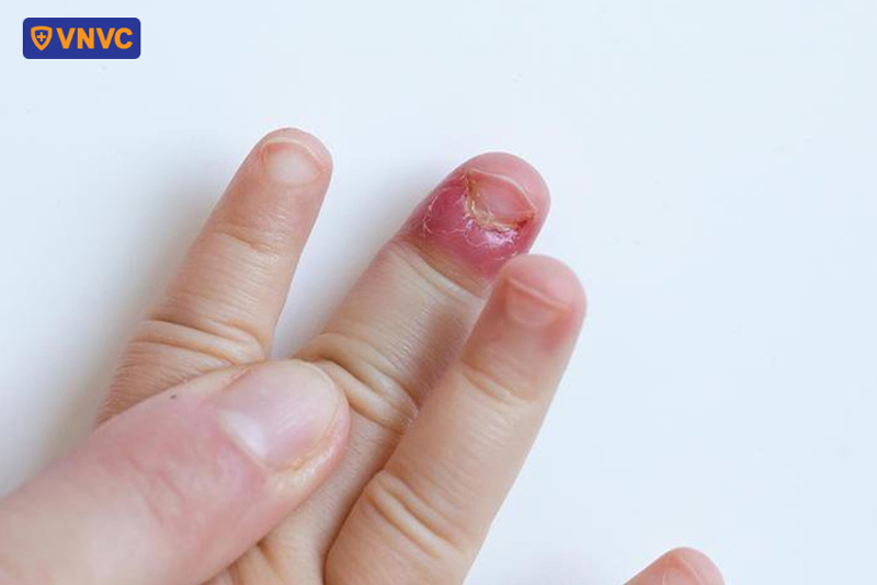 tay chân miệng gây mất móng tay