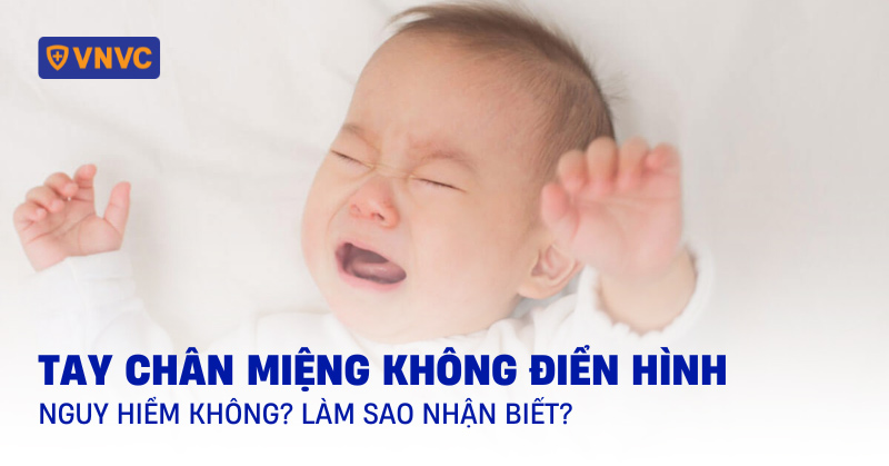 tay chân miệng không điển hình