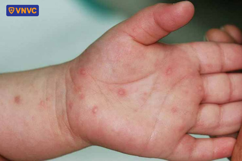 tay chân miệng thường xuất hiện nhiều bóng nước
