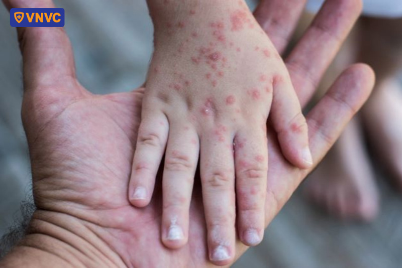 tay chân miệng ủ bệnh bao lâu