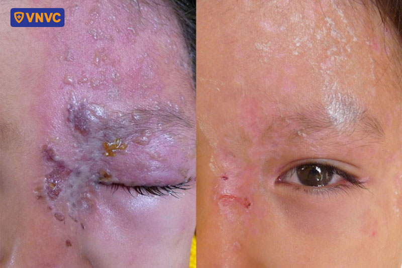 tổn thương phồng rộp và lan đến mí mắt, chóp mũi