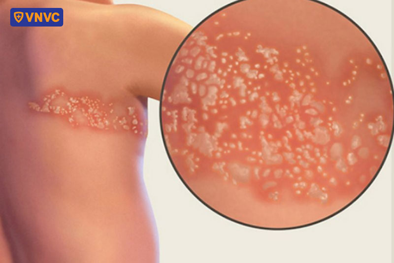 trẻ sơ sinh bị giời leo là do varicella zoster gây ra