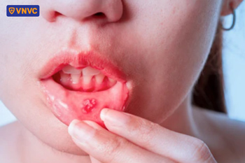 vết loét ở nhiệt miệng