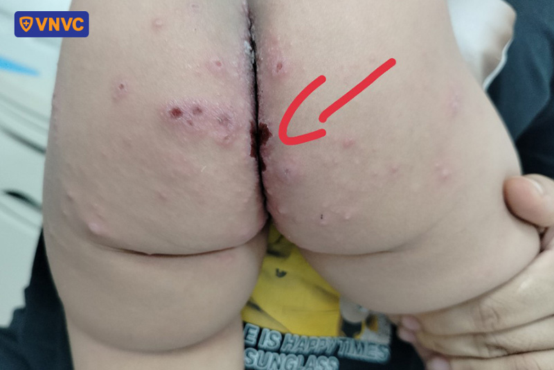 vết loét tay chân miệng ở mông