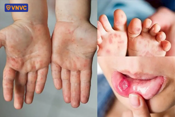 vết loét tay chân miệng
