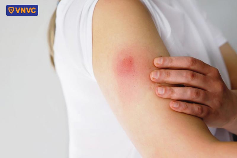 vết tiêm hpv bị sưng đỏ