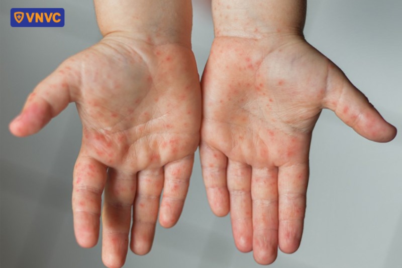 virus tay chân miệng tồn tại trên bề mặt khô cứng