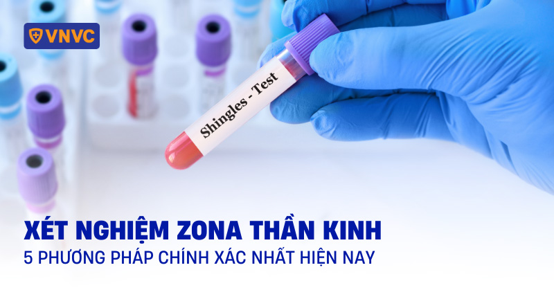 Xét nghiệm zona thần kinh: 5 phương pháp chính xác nhất hiện nay