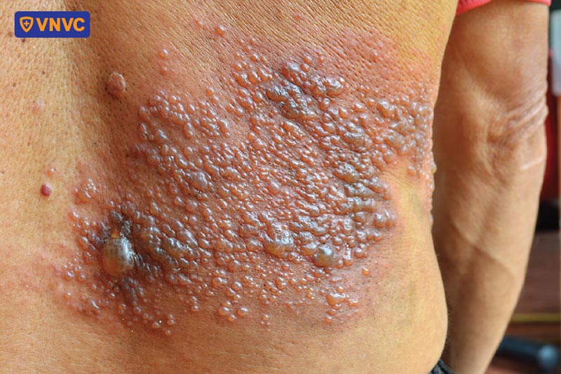 zona thần kinh ở lưng