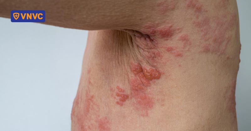 zona thần kinh ở người có bệnh nền