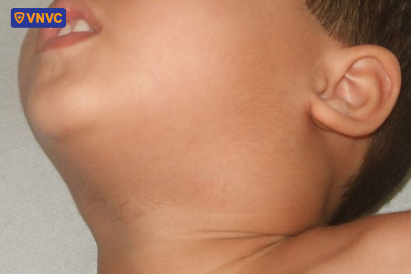 bạch hầu gây sưng hạch bạch huyết