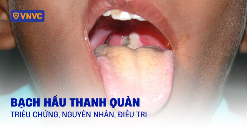 bạch hầu thanh quản