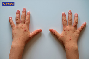 ban ở tay chân miệng dạng phỏng nước