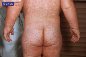 ban sởi nổi khắp người