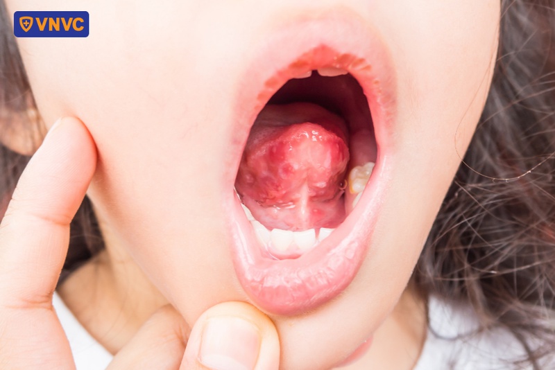 bé bị tay chân miệng nhưng không nổi mụn nước