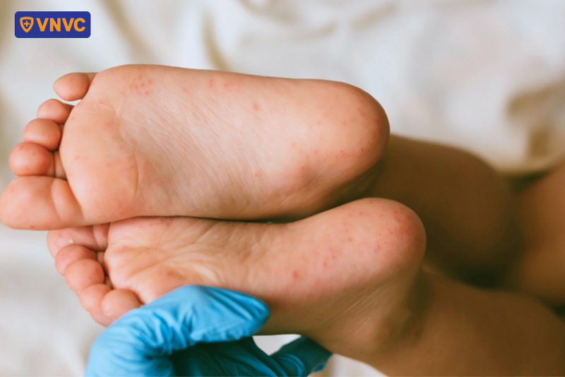 bé bị tay chân miệng tắm lá gì