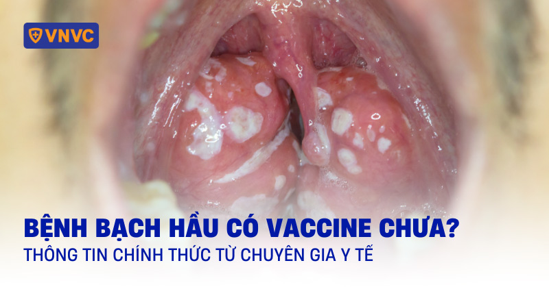 bệnh bạch hầu có vaccine chưa
