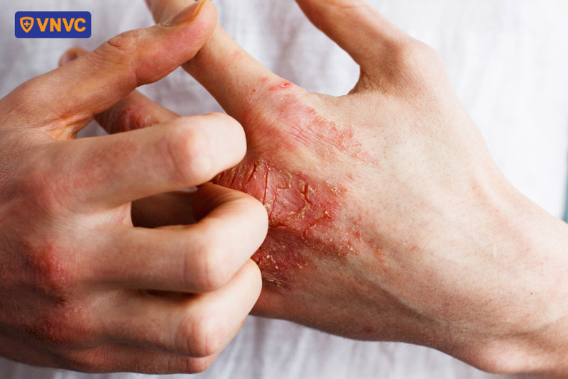 bệnh nhân viêm khớp vảy nến