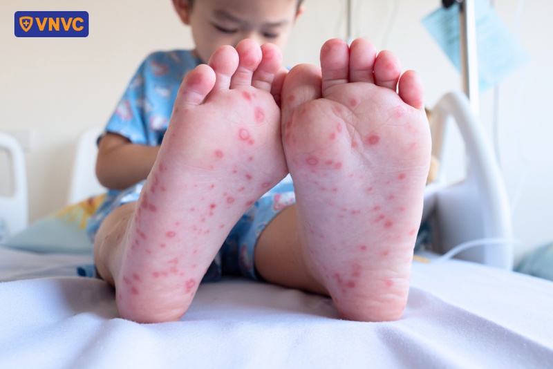 bệnh tay chân miệng cách ly bao lâu