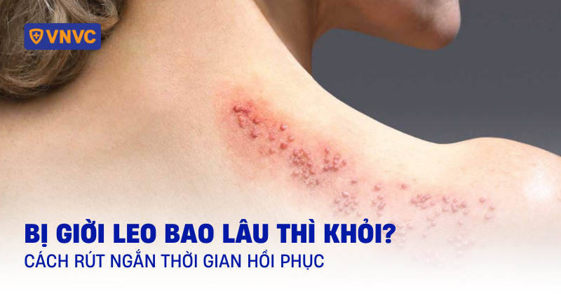 bị giời leo bao lâu thì khỏi