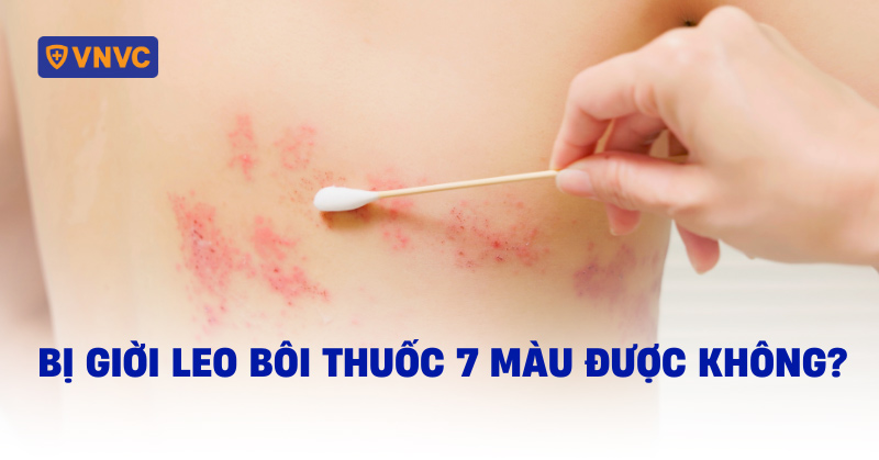bị giời leo bôi thuốc 7 màu được không