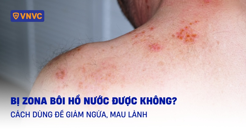 bị zona bôi hồ nước được không