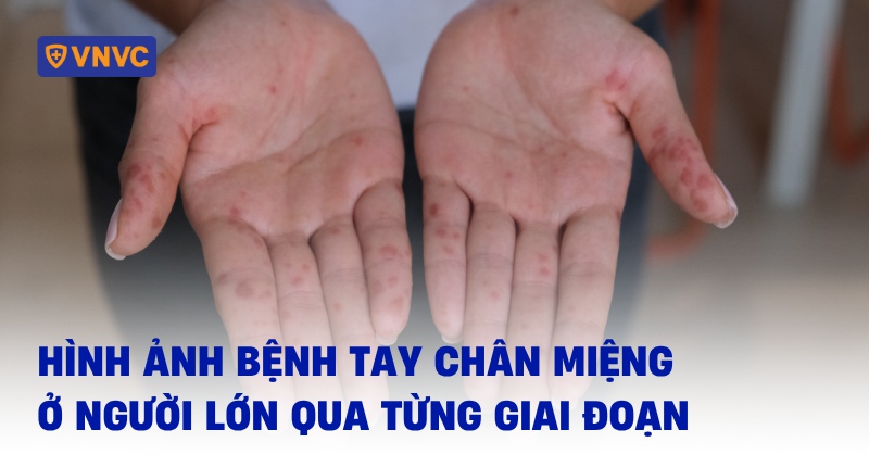 các hình ảnh bệnh tay chân miệng ở người lớn
