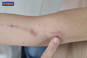 da hồi phục sau khi kiến ba khoang cắn