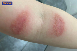 da tiếp xúc với độc tố kiến ba khoang