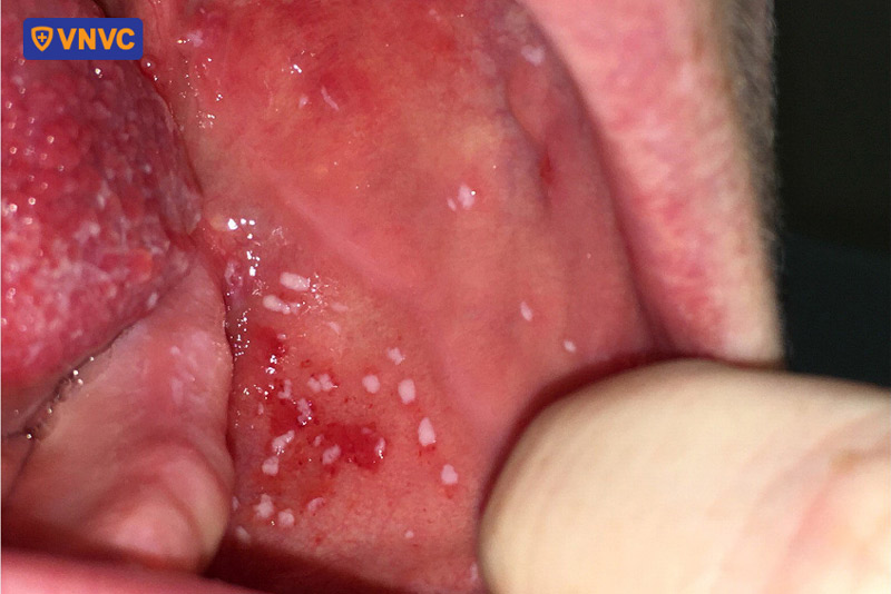 đốm Koplik do sởi